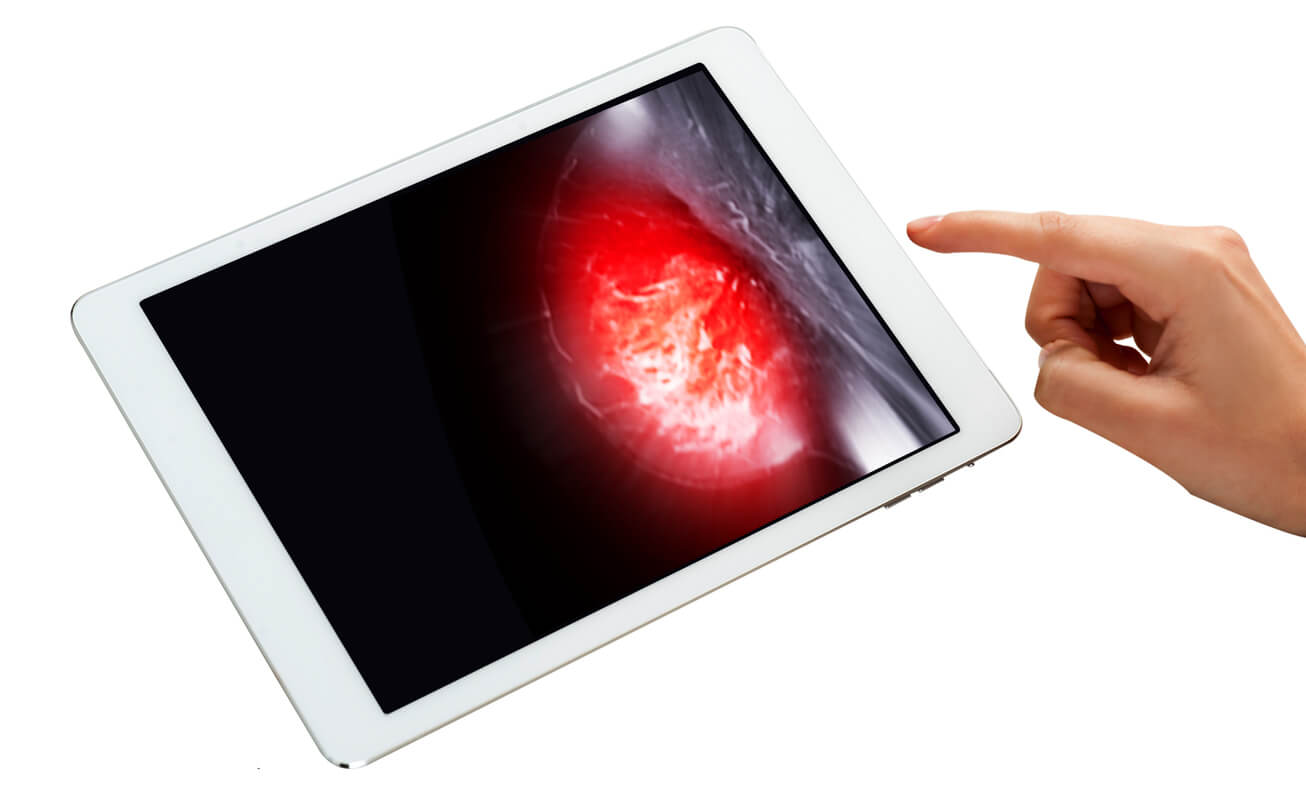 Mammography